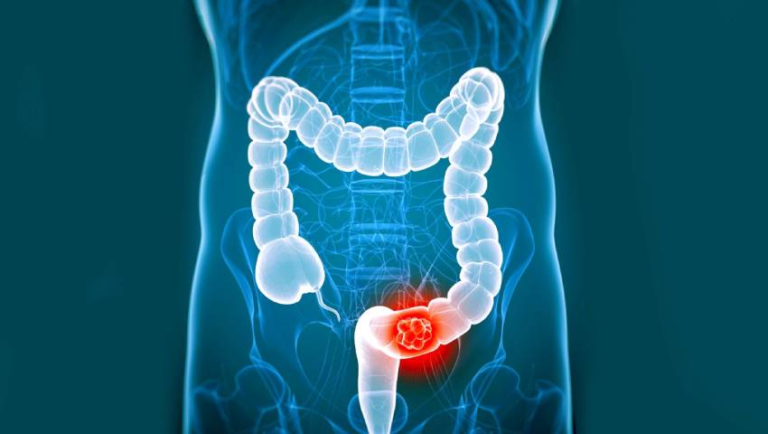 Early Detection and Treatment in Colorectal Health